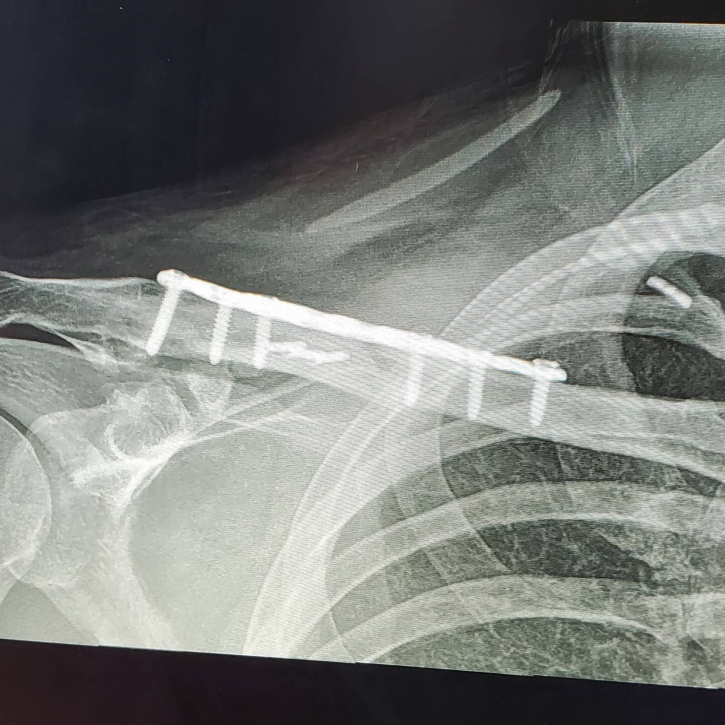 Bezzecchi opéré après sa fracture au Sachsenring - Article MotoGP en vedette sur PitStopInsight