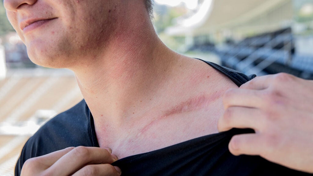 clavicle-surgery_2.jpg